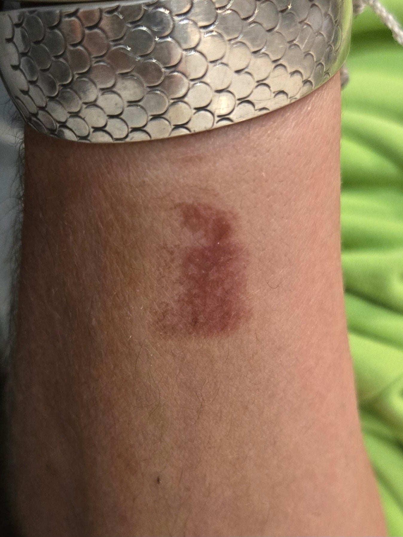 Natural Burn Care Results: How Butter Me Up Helped My Skin Heal Without Scarring